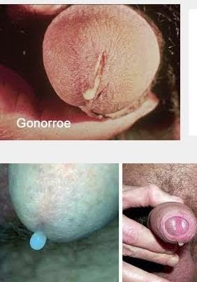 Image Jamu Untuk Obat Kencing Nanah