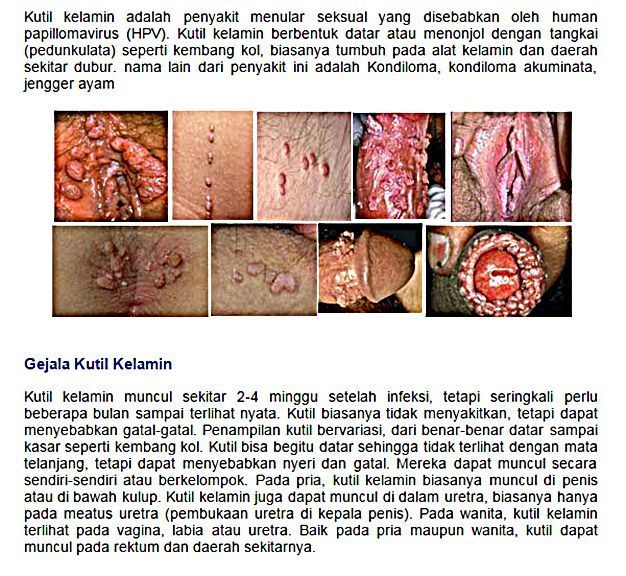 Obat Kutil Kelamin Di Tanah Luas,Pengobatan Kutil Kelamin Di Batu Brak,Obat Kutil Kemaluan Di Padureso,Obat Herbal Kutil Kelamin Di Kota Padang,Obat Kutil Kelamin Denature Di Dolok Sanggul,Kutil Pada Daerah Kelamin